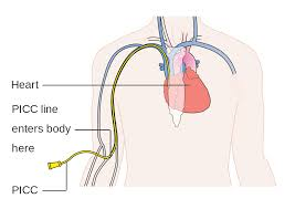 how does a picc line work diagram of where the picc line goes into heart